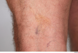 Neeo broken blood vessels knee skin 0001.jpg